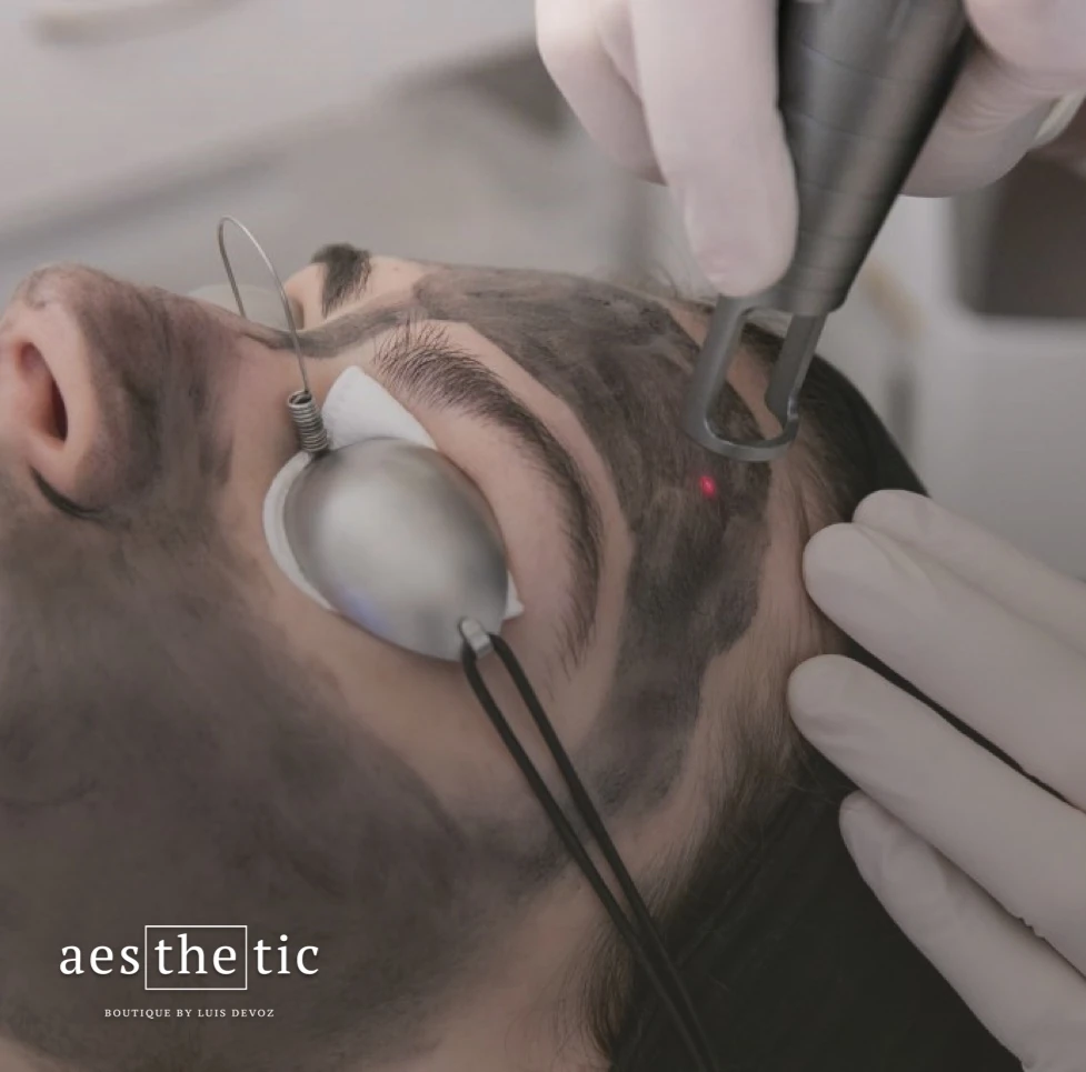 peel Hollywood Peel carbon laser en Bogotá - The Aesthetic